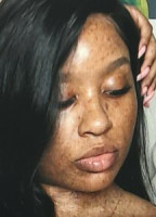 FRECKLEDN