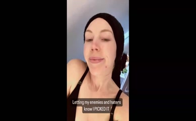 Katherine Ryan bare face acne.