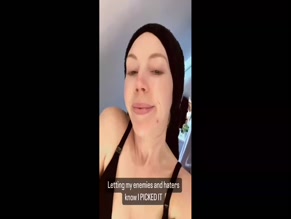 Katherine Ryan bare face acne.